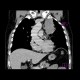 Lung carcinoma, metastasis: CT - Computed tomography